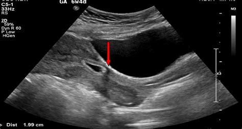 Ectopic Pregnancy Ultrasound Vs Normal Pregnancy