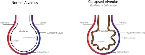 Respiratory Distress Syndrome (RDS) in Neonates