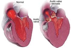 Subaortic stenosis may be congenital (present at birth) or acquired as ...