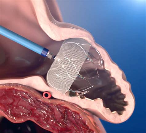 NVAF Patient Selection for WATCHMAN – For Physicians