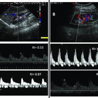 The tardus et parvus waveform in a patient with renal artery stenosis.... | Download Scientific ...