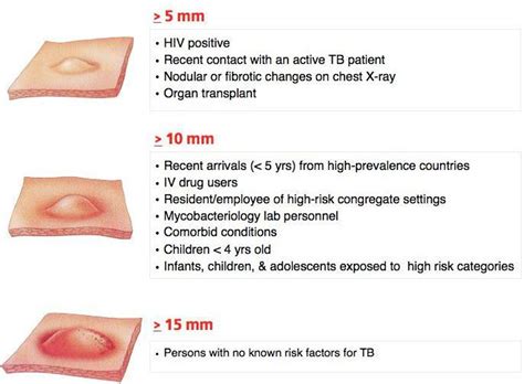 Classification of the PPD (Tuberculin Skin Test) Reaction - MEDizzy