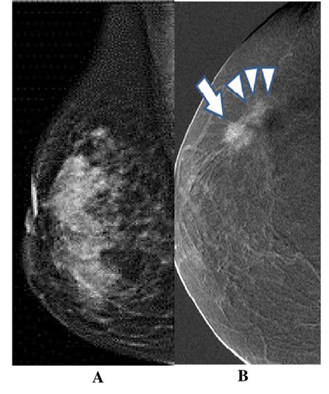 Invasive ductal carcinoma in a 52-year old female. (A) The right... | Download Scientific Diagram