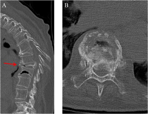 Computed tomography images of the T9 burst fracture with retropulsion... | Download Scientific ...