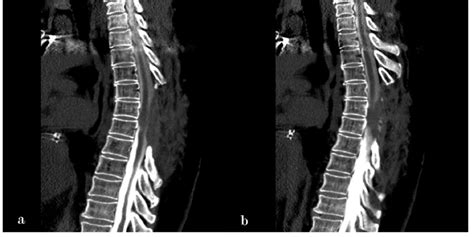 Sagittal CT myelogram of the thoracic spine (MRI was not performed due... | Download Scientific ...