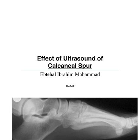 Effect of Ultrasound of Calcaneal Spur.pdf | DocDroid