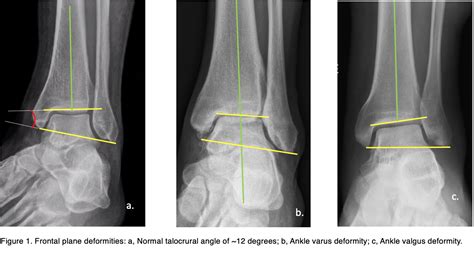 Valgus Vs Varus Of Ankle