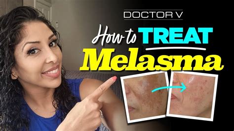 Doctor V - How To Treat Melasma | Skin Of Colour | Brown Or Black Skin - YouTube