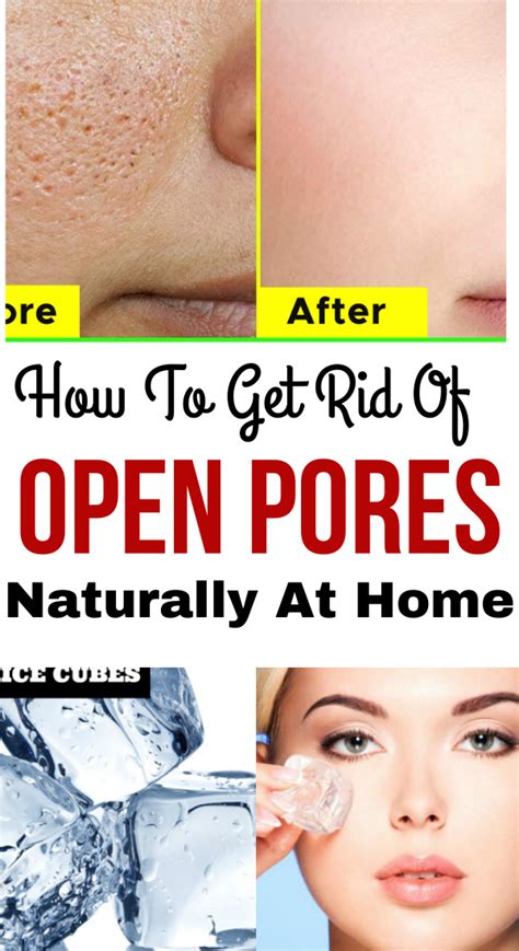 Open Pores Remedy: How To Get Rid Of On Face | Skin care wrinkles, Open pores on face, Natural ...