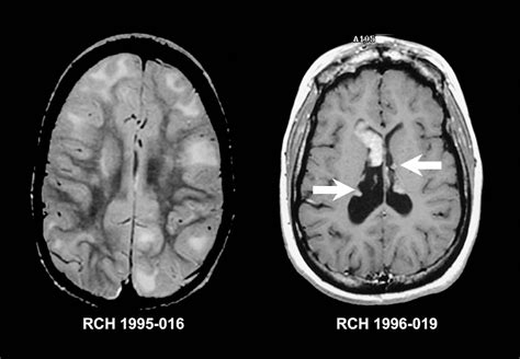 Common Warning Signs of a Brain Tumor | Page 9 | Things Health