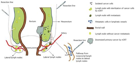 Rectal Cancer Home Remedies: Rectal Cancer To Lymph Nodes