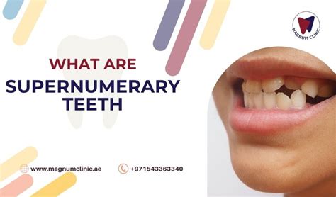 What are supernumerary teeth, syndrome, causes, extraction