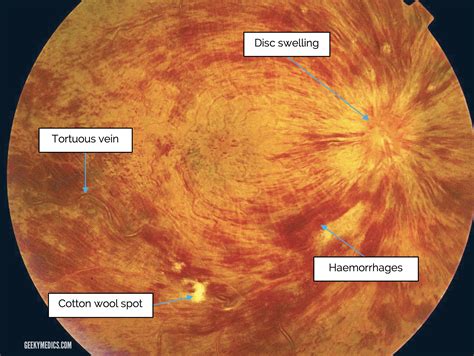 Fundoscopic Appearances of Retinal Pathologies | Geeky Medics