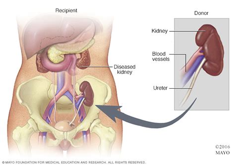 Everything that you need to know about kidney transplant survival rate and recovery | Timeslifestyle