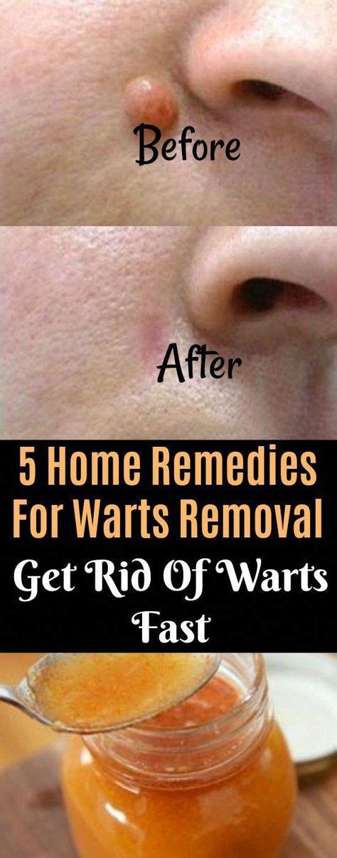 Proven methods to Get rid of Warts Naturally #WartsOnHands in 2020 | Home remedies for warts ...