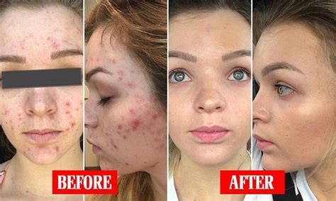 21-year-old fitness blogger shares amazing acne transformation | Celebrity acne, Jawline acne ...