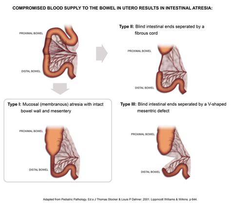 Stricture of the small intestine (Intestinal atresia) | Pathology Learning Centre