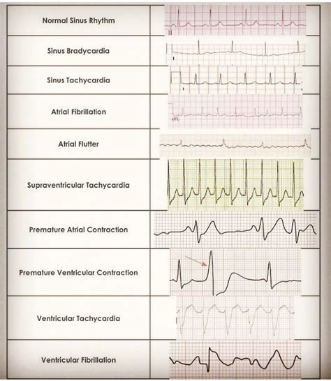 Printable Ekg Rhythm Interpretation Cheat Sheets