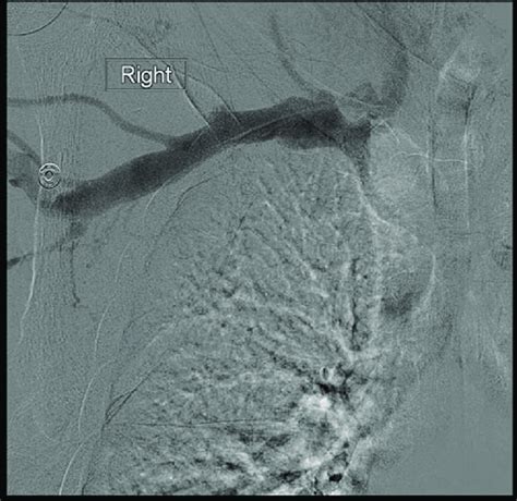 The shuntogram confirmed the findings of computed tomography venography. | Download Scientific ...