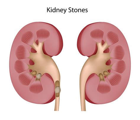 Kidney stones | Staffordshire Urology Clinic