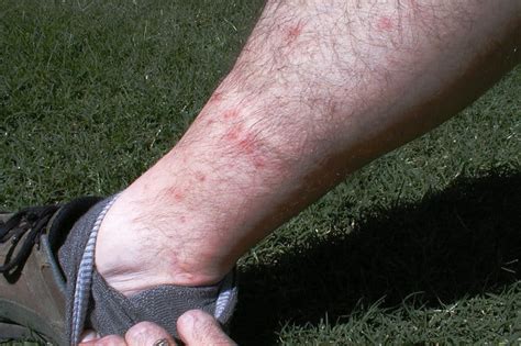 How Long Do Chiggers Live on Your Skin? - Skin Care Geeks