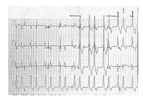 Differential Diagnosis of Wide QRS Complex Tachycardias - The Clinical Advisor