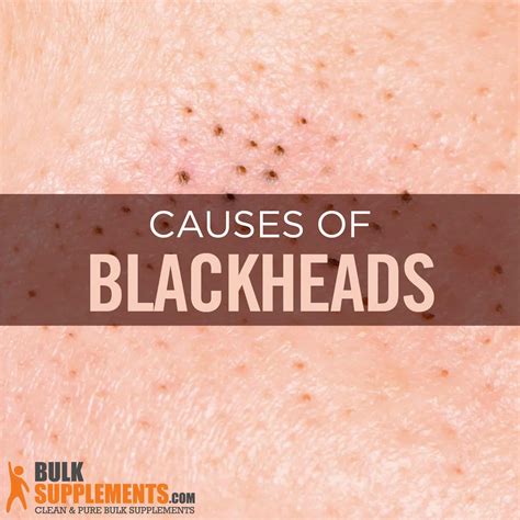 Blackheads Archives