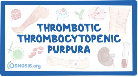 Thrombotic thrombocytopenic purpura: Video, Causes, & Meaning | Osmosis