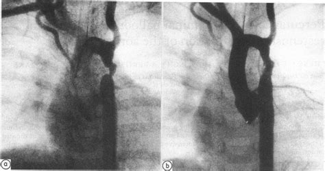 Aortography before (a) and after (b) percutaneous transluminal balloon... | Download Scientific ...