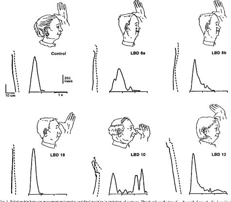 Figure 1 from Ideomotor apraxia and cerebral dominance for motor control. | Semantic Scholar