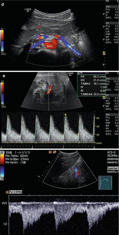 Splenic Vein Ultrasound