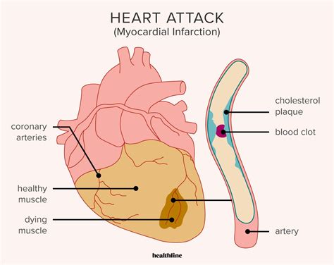 Heart attack symptoms causes diagnosis prevention more – Artofit