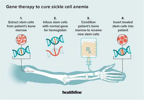 Sickle Cell Anemia and Gene Therapy: How It Works