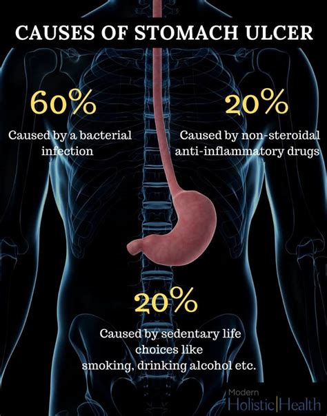 What Is Stomach Ulcer