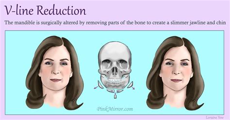 Facial fat – What kind of corrective procedure or surgery is right for ...