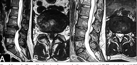 Figure 3 from Transforaminal Endoscopic Discectomy versus ...