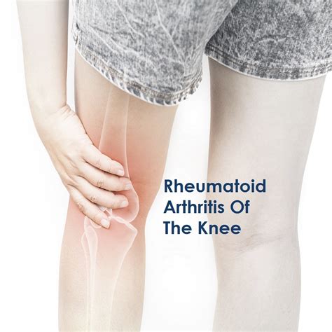 Treating Rheumatoid Arthritis Of The Knee - Dr. Amyn Rajani's Blog