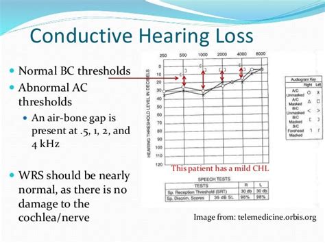 Audiogram interpretation