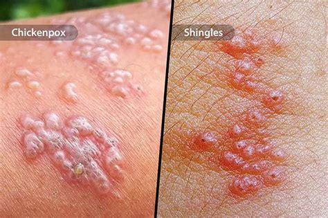 Skin Problems: Blisters Causes and Treatment