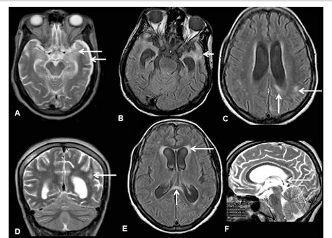 Syphilis Brain Mri