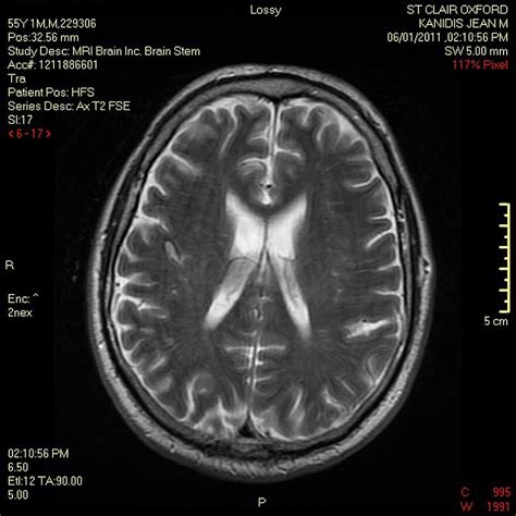 HD wallpaper: brain, scan, mri, demyelinating, medical, doctors ...