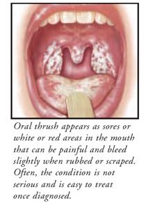 Thrush Throat