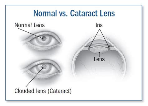 Cataract: Symptoms, diagnosis, and treatment - Harvard Health