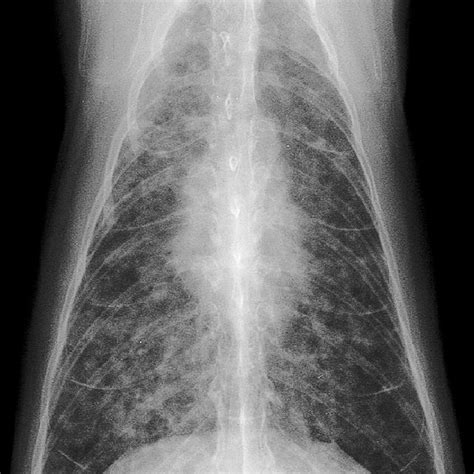 Lung; cat No. 1. Diffuse, severe bronchointerstitial pattern ...