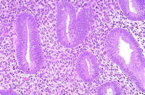 What Is Proliferative Phase Endometrium and Secretory Endometrium ...