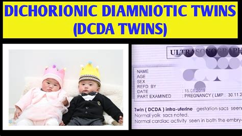 DCDA TWIN PREGNANCY IN HINDI| DCDA TWINS MEANING|, 56% OFF