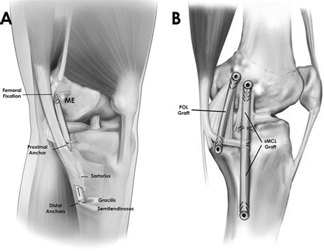 Augmented ACL reconstruction procedure | The Better Parent