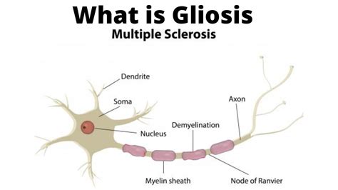 What is Gliosis - YouTube