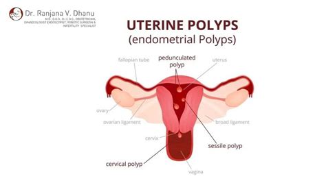 Endometrial polyps causes symptoms and its treatment