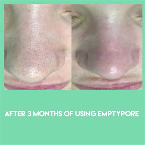 EmptyPore™ Sebaceous Filament Removal Machine – Clevive